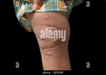 Infestation de gale avec infection bactérienne secondaire ou superposée et pustules dans la jambe de l'Asie du Sud-est, enfant birman. Banque D'Images