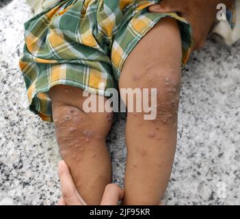 Infestation de gale avec infection bactérienne secondaire ou superposée et pustules dans la jambe de l'Asie du Sud-est, enfant birman. Banque D'Images