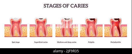 Stades de caries et de destruction des dents de la tache à la parodontite illustration réaliste de vecteur isolé Illustration de Vecteur