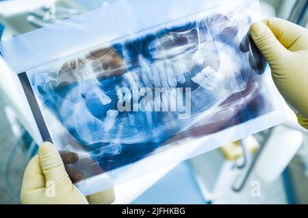 Le dentiste étudie la radiographie avant l'implantation Banque D'Images