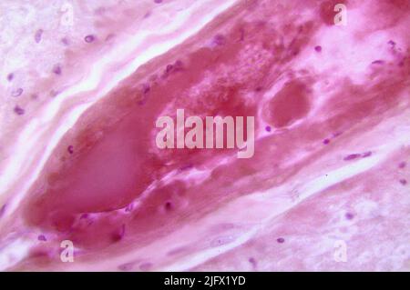 Un photomicrographe de la moelle épinière lombaire représentant un infarctus de la polio de type III entourant l'artère spinale antérieure. Quand les neurones spinaux eux-mêmes meurent, la dégénérescence wallonne se produit entraînant une faiblesse musculaire de ces muscles une fois innervés par les neurones maintenant morts (dénervés). Le degré de paralysie est directement lié au nombre de neurones décédés. Une version optimisée et améliorée d'une image produite par les Centers for Disease Control and Prevention des États-Unis / Credit CDC /Dr.Karp Banque D'Images