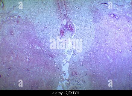 Un photomicrographe de la moelle épinière lombaire illustrant des changements dégénératifs dus à un infarctus causé par la polio de type III Quand les neurones spinaux eux-mêmes meurent, la dégénérescence wallonne se produit entraînant une faiblesse musculaire de ces muscles une fois innervés par les neurones maintenant morts (dénervés). Le degré de paralysie est directement lié au nombre de neurones décédés. Une version optimisée et améliorée d'une image produite par les Centers for Disease Control and Prevention des États-Unis / Credit CDC /Dr.Karp Banque D'Images