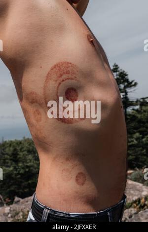 Gros plan de la peau après une séance de cupping ou de vide traditionnelle. Image avec espace de copie. Ecchymose sur le corps. Photo de haute qualité Banque D'Images