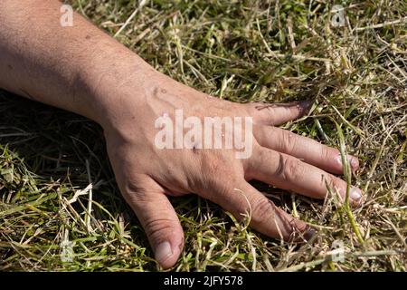 Cas léger de psoriasis ou d'eczéma sur les mains Banque D'Images