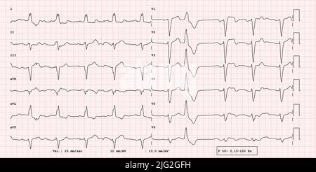 ECG 12 dérivations pathologique, bloc de branche droit, battement supraventriculaire prématuré, bloc auriculo-ventriculaire BAV premier degré, examen réel Banque D'Images