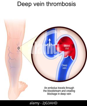 Thrombose veineuse profonde. Un embole traverse le flux sanguin et crée un bloc dans la veine profonde. Gros plan du vaisseau sanguin avec un caillot de sang. Coupe transversale Illustration de Vecteur