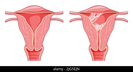 Ensemble du syndrome d'Asherman le système reproducteur féminin cicatrice les adhérences du tissu dans l'utérus. Vue de face dans une coupe. Sick and normal Human Anatomy Internal Orgues location Scheme Fallope tube Flat style icône Illustration de Vecteur