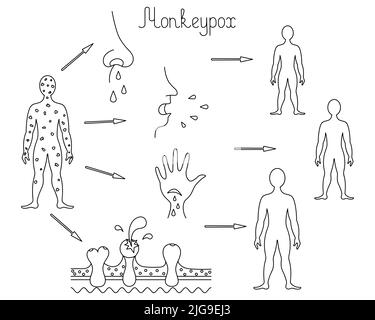 Méthodes d'infection humaine par la variole du singe, transmission de la variole d'une personne à l'autre Illustration de Vecteur