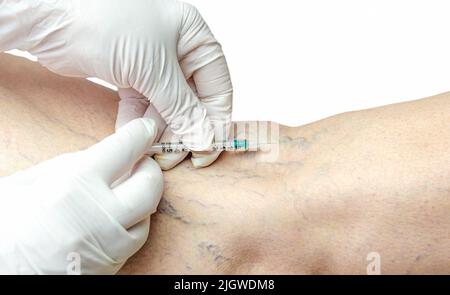 Sclérothérapie sur les jambes d'un homme caucasien adulte. Retrait des varices par injection par un médecin en gants blancs. Veines atrophiées. Banque D'Images