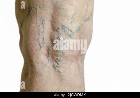 Jambe de femme plus âgée avec varices, thrombose veineuse profonde. Isolé sur fond blanc. Télangiectasias. Banque D'Images