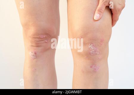 Arthrite psoriasique avec psoriasis cutané sur les genoux d'une femme. Arthrite inflammatoire causant de l'enflure, de la raideur, de la rougeur, de la douleur et des lésions articulaires Banque D'Images