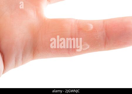 Des cloques apparaissent sur le doigt. Traumatisme médical avec peau sèche pour les soins dermatologiques, gros plan du corps avec des dommages à la peau humaine isolée sur la ba blanche Banque D'Images