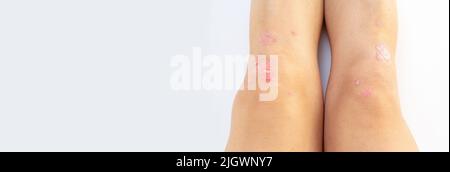 Arthrite psoriasique avec psoriasis cutané sur les genoux d'une femme. Liquide synovial chez un patient atteint de psoriasis de l'articulation gauche du genou. Arthrite inflammatoire Banque D'Images