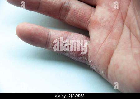 Maladie de la peau pour beaucoup de personnes - eczéma sur la main et le doigt. Fond de couverture blanc. Banque D'Images