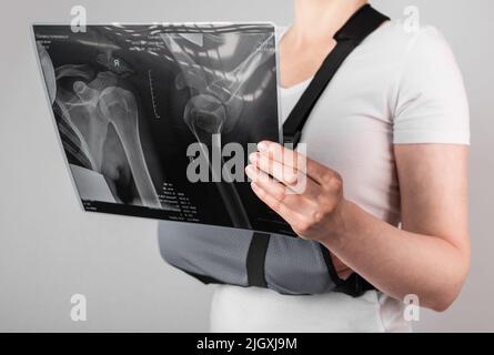 Femme portant un harnais de bras et regardant une image radiologique. Femme souffrant d'épaule, clavicule, fracture d'acromion, souche. Soins de santé, concept de diagnostic des blessures. Photo de haute qualité Banque D'Images