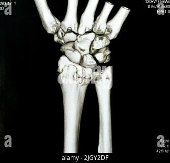 La vue 3D de l'articulation du poignet droit de l'acquisition CT montre une fracture du rayon distal droit pour une réduction fermée et un foyer sélectif moulé d'une imagerie d'acquisition CAT montrant la fracturation Banque D'Images