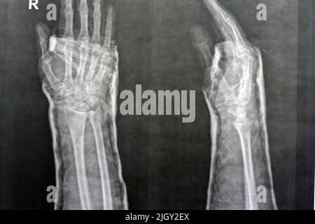 L'articulation droite du poignet à rayons X simple montre une fracture du rayon distal droit, une réduction fermée et un foyer sélectif de l'imagerie radiographique montrant la fracture ra Banque D'Images