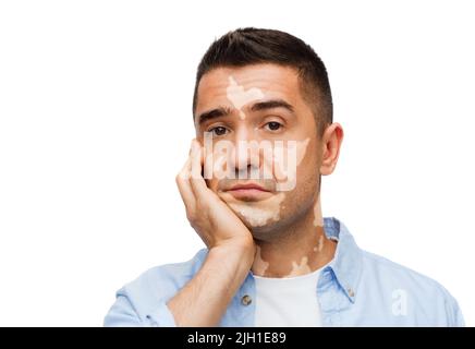 triste malheureux homme avec le vitiligo Banque D'Images