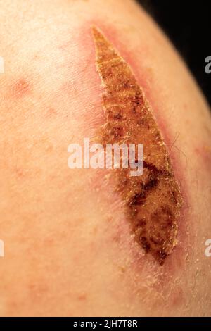 Une grande gale séchée sur le bras d'un homme. La blessure est due à un accident de vélo. Banque D'Images