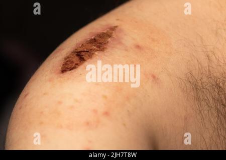 Une grande gale séchée sur le bras d'un homme. La blessure est due à un accident de vélo. Banque D'Images