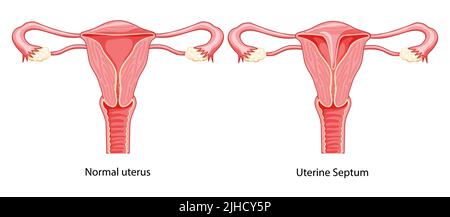 Ensemble de septum utérin cloisonné utérus normal et avec maladie Schéma du système reproducteur féminin. Vue de face dans une coupe. Schéma d'anatomie humaine, Icon de style plat du col de l'utérus Illustration médicale vectorielle isolée Illustration de Vecteur