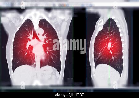 CT thorax ou CT acquisition du poumon vue coronale et sagittale pour le diagnostic TB, tuberculose et coronavirus ou covid-19 . Banque D'Images
