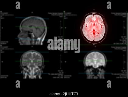 IRM cerveau axial flair pour détecter la maladie d'accident vasculaire cérébral et les tumeurs et les kystes du cerveau. Banque D'Images