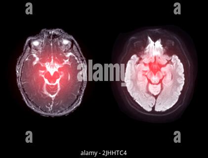 Image de diffusion axiale du cerveau IRM pour détecter les accidents vasculaires cérébraux et les tumeurs et kystes du cerveau. Banque D'Images