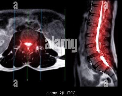 IRM rachis lombaire ou rachis lombaire vue axiale T2W avec plan sagittal pour le diagnostic de la compression de la moelle épinière. Banque D'Images