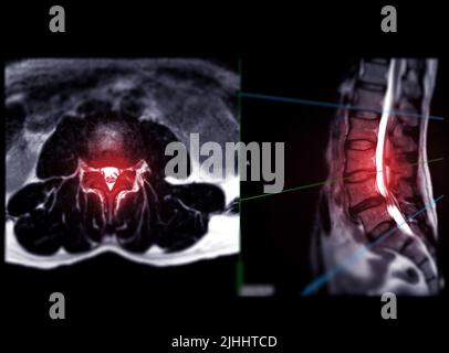 IRM rachis lombaire ou rachis lombaire vue axiale T2W avec plan sagittal pour le diagnostic de la compression de la moelle épinière. Banque D'Images