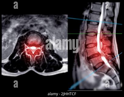 IRM rachis lombaire ou rachis lombaire vue axiale T2W avec plan sagittal pour le diagnostic de la compression de la moelle épinière. Banque D'Images