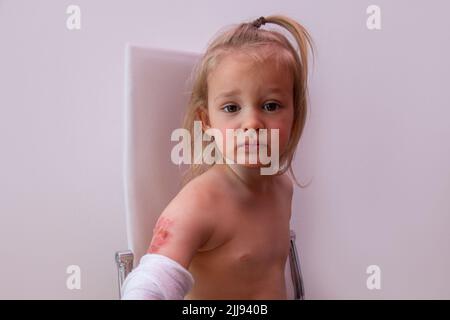 Tout-petit avec blessure brûlée sur le bras sur fond blanc, brûlures et brûlures chez un enfant Banque D'Images