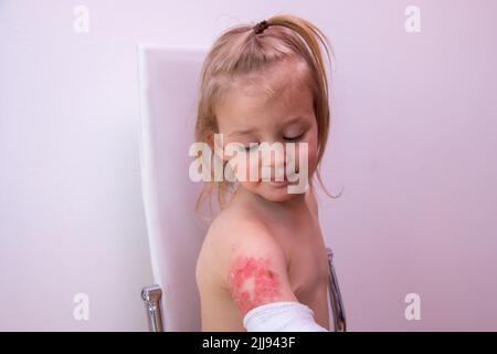 Tout-petit avec blessure brûlée sur le bras sur fond blanc, brûlures et brûlures chez un enfant Banque D'Images