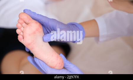 Éruption cutanée avec infection à entérovirus de la famille des picornavirus sur les pieds de l'enfant Banque D'Images