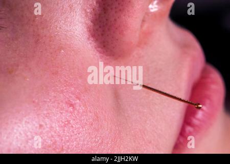 Un portrait d'une petite aiguille d'acupuncture accrochent dans le visage d'une personne à côté du nez, pour soulager le stress, guérir la douleur ou une autre condition médicale avec Banque D'Images