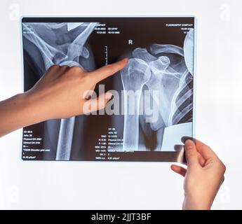 Index pointant vers une image radiologique du bras en vue d'un traumatisme. Acromion, fracture acromiale. Médecin présentant une lésion d'épaule et de clavicule. Identification et diagnostic des problèmes médicaux. Photo de haute qualité Banque D'Images