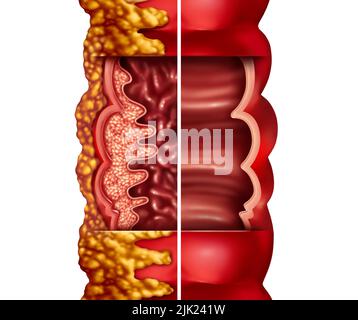 Maladie de Crohn et syndrome de Crohn maladie ou maladie de crohns et côlon sain comme concept médical avec un gros plan d'un intestin humain Banque D'Images