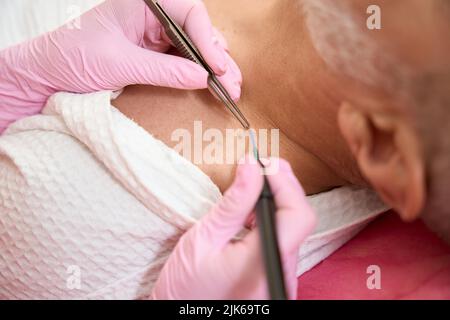 Les mains des femmes dermatologues éliminent les néoplasmes à l'aide de scalpel à ondes radio Banque D'Images