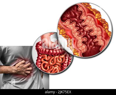 La maladie de Crohn la douleur et le syndrome de Crohn la maladie ou le trouble de crohns comme concept médical avec un gros plan d'un intestin humain avec inflammation. Banque D'Images