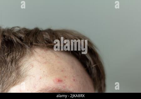 Photo de l'acné sur le visage d'un adolescent. Boutons, étoiles rouges et points noirs sur le front.le concept de problème de peau, de soin et de beauté Banque D'Images