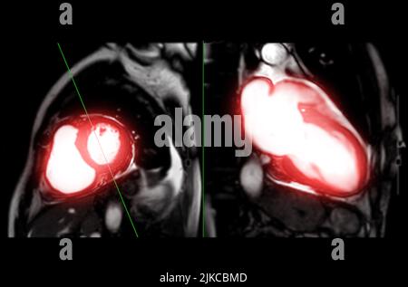 IRM cardiaque ou cardiaque IRM ( imagerie par résonance magnétique ) du cœur sur un axe court et une vue verticale sur un axe long montrant les battements cardiaques pour détecter le cœur d Banque D'Images