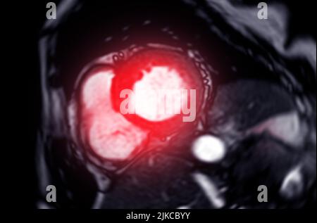 IRM cardiaque ou cardiaque IRM (imagerie par résonance magnétique) du cœur dans une vue à axe court montrant le plan de battement cardiaque pour détecter une maladie cardiaque. Banque D'Images