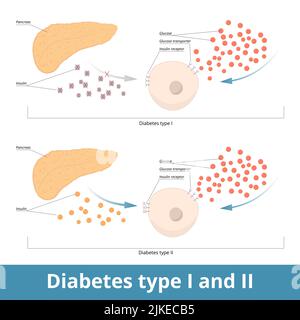 Diabète de type I et II Visualisation schématique de deux types de diabète : le pancréas ne produit pas d'insuline et les cellules ne peuvent pas l'utiliser. Illustration de Vecteur