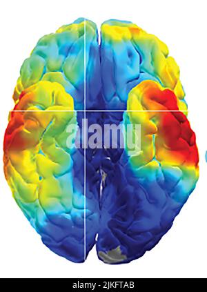 Les scientifiques des NIH ont utilisé des enregistrements électriques pour étudier comment le cerveau humain se souvient. Dans deux études, des scientifiques des National Institutes of Health ont exploré comment le cerveau humain stocke et récupère des souvenirs. Une étude suggère que le cerveau étache chaque mémoire en schémas de tir uniques de neurones individuels. Pendant ce temps, la deuxième étude suggère que le cerveau relit les souvenirs plus rapidement qu'ils ne sont stockés. Banque D'Images