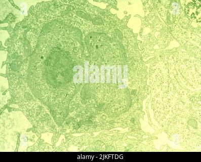 Une diapositive histologique de la leucémie à tricholeucocytes. Banque D'Images