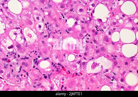 Image microscopique du tissu hépatique affecté par une stéatose hépatique non alcoolique (NAFLD). Les gros et petits points blancs sont des gouttelettes de graisse en excès qui développent des cellules hépatiques (hépatocytes). Banque D'Images