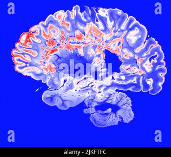 Il s'agit d'une image pseudo-colorée d'une IRM à écho de gradient haute résolution d'un hémisphère cérébral fixe d'une personne atteinte de sclérose en plaques. Banque D'Images