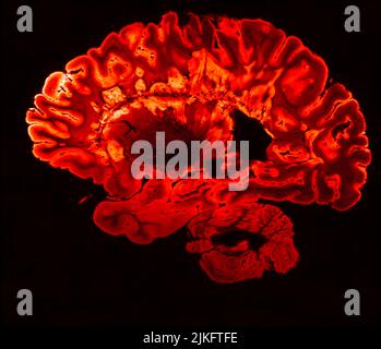Il s'agit d'une image pseudo-colorée d'une IRM à écho de gradient haute résolution d'un hémisphère cérébral fixe d'une personne atteinte de sclérose en plaques. Banque D'Images