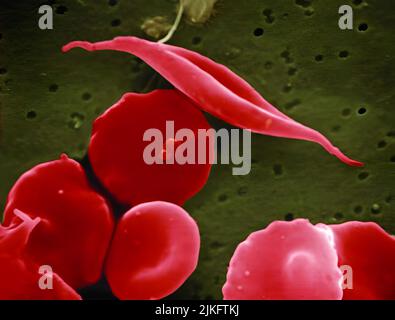 La drépanocytose est une maladie génétique du sang qui endommage les globules rouges. La maladie touche des millions de personnes dans le monde entier et environ 80 000 patients aux États-Unis, en particulier une naissance afro-américaine sur 500. Un défaut dans l'hémoglobine (une protéine qui aide les cellules à transporter l'oxygène à travers le corps) causant des globules rouges à devenir raides et en forme de croissant (faucille), bloquant les petits vaisseaux sanguins et causant une diminution du flux sanguin, inflammation, douleur et accidents vasculaires cérébraux. Enfants. Banque D'Images