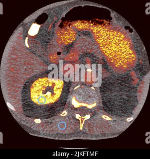 Image d'acquisition CT photonique d'un sujet de recherche au NIH. Des quantités plus importantes de contraste d'iode sont affichées dans des couleurs jaunes plus lumineuses. Banque D'Images